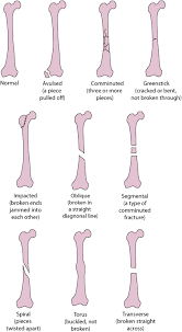Overview Of Fractures Dislocations And Sprains Medical Radiography Basic Anatomy And Physiology Diagnostic Radiography