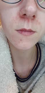 Who does not like the natural blush on cheeks? Vitamin D Eczema Reddit