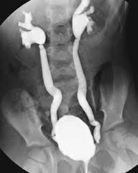 Image result for Voiding Cystourethrogram
