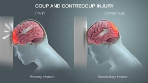 Image result for Brain Contusion