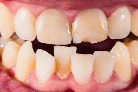 Pearly whites need not mean that all is well. Things To Know About Dental Tartar Removal