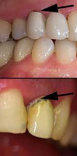 Dunkle Zahn Kronenrander Sind Unschon Und Heute Nicht Ublich Manchmal Durch Dunkle Zahnwurzel Internes Bleaching Kann Helfen Dentalnews