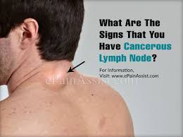 At diagnosis, less than 15 percent of hypopharyngeal cancers are confined to the hypopharynx. What Are The Signs That You Have Cancerous Lymph Node