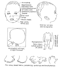 In asians it is normal, but in caucasians it may indicate an underlying syndrome. Clincal Features 1 Acrocephaly 2 Flat Nasal Bridge 3 Syndactyly Download Scientific Diagram