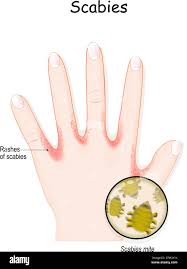 Image result for scabies on humans