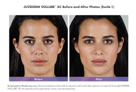 JUVÉDERM VOLLURE™ XC