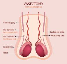 Check spelling or type a new query. Vasectomy Expectations And Effectiveness Menmd