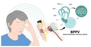 Image result for Vertigo Management