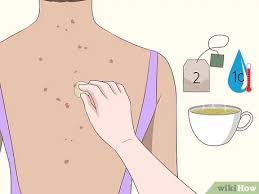 Use a cotton ball to apply fresh lemon juice to the affected area. 3 Ways To Get Rid Of Back Acne Scars Wikihow