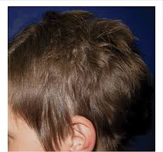 Alopecia universalis (au) is a condition characterized by the complete loss of hair on the scalp and body. Alopecia Areata With Cosmetically Acceptable Regrowth With Methotrexate Download Scientific Diagram