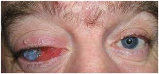 Get directions to our office! Silicone Oil Migration Causing Increasing Proptosis 13 Years After Retinal Surgery Eye