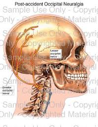 Post Accident Occipital Neuralgia Occipital Neuralgia Neuralgia Occipital