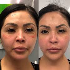 Thread lift before and after eyes. Pdo Thread Lift Skin Perfect Brothers Laser Hair Removal Botox Filler Wrinkles Anti Aging Volume Brown Spots Walnut