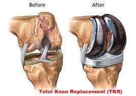 Dr Shailendra Patil Is Best Orthopedic Knee Replacement Surgery Cost Specialists In Thane Mul Knee Replacement Total Knee Replacement Knee Replacement Surgery