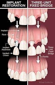 Glen Hill Dental Has Experience With Both Procedures Decide Which One Is Best For You And Give Us A Call Today 203 79 Implant Dentistry Dental Implants Dental