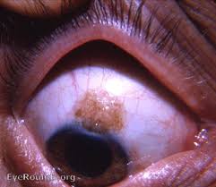 Image result for conjunctival melanoma