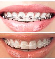 Check spelling or type a new query. Quick Straight Teeth Carramar Joondalup Wa Diamond Smiles Dental