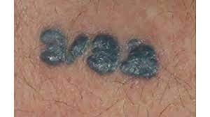 Tattoo Allergy Rash And Other Reactions To Ink Treatment More