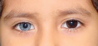 Only one percent of the population has this condition. Heterochromia Or Human Chimeras Can A Person Have Two Differently Coloured Eyes Steemit