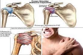 Hombro Congelado Ayurveda Tibetano Hombro Congelado Capsulitis Adhesiva Hombres