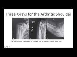 Upper extremity emergency medicine by matthew wong. Shoulder Arthritis Rotator Cuff Tears Causes Of Shoulder Pain X Rays For Shoulder Arthritis