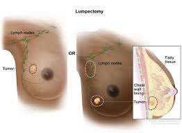 Image result for Mastectomy