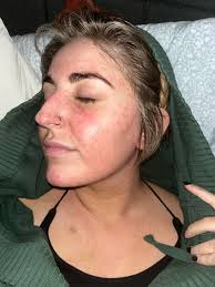 What can I use to help with itch naturally?