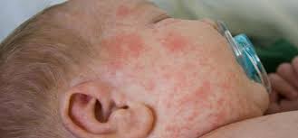 Image result for vyrážka u dětí