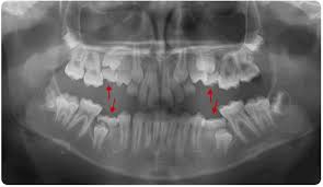 Ankylosis Primary Second Molars Teeth Treatment Teeth Orthodontics