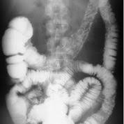 X Ray Imaging Explained Learn About Equipment Uses And Images Large Bowel Crohns Disease Gastrointestinal System