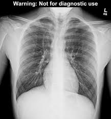 Image result for Pneumothorax