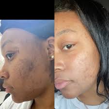 SKYN TOUCHÉ ( Formerly PREMIER PRETTY SKIN)