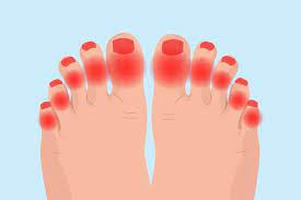 But it only lasts a few seconds as the connection returns to normal worried about your sleepy feet? Arthritis In Toes Symptoms Causes Diagnosis And Treatment
