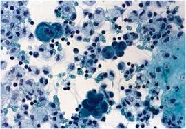 Among these were 26 (1.6% of . Pathologic Diagnosis And Classification Of Mesothelioma Springerlink