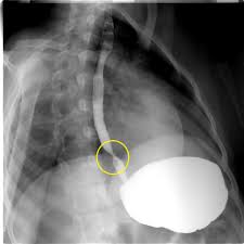 In case of significant obstruction of the esophageal lumen by esophageal web and persistent dysphagia despite iron supplementation, rupture and dilation of the web are necessary. Plummer Vinson Syndrome Differential Diagnosis Wikidoc