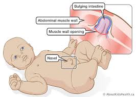 Image result for Inguinal hernia child