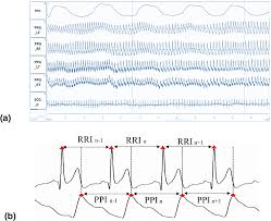 Evaluation Of Coherence Between Ecg And Ppg Derived