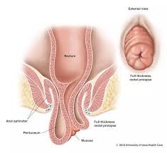 Image result for Rectal Prolapse