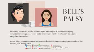 Bell's palsy kurang tidur bell's palsy adalah penyakit saraf yang mengenai saraf pada wajah, apa saja gejalanya ? Bell S Palsy Dalam Kehamilan Bidan Kita