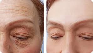 We did not find results for: Can You Get Botulism From Botox Doctor For Botox Evolution Medspa Boston