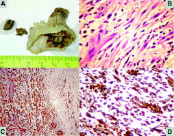 Image result for Leiomyosarcoma