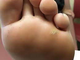 As with any other plantar warts, they are often time mistaken to be a callous (just as vice versa, calluses may be mistaken for plantar warts). Plantar Warts Epidemiology Pathophysiology And Clinical Management