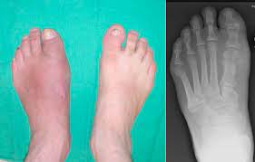 Current Concepts Of Charcot Foot In Diabetic Patients Sciencedirect