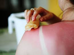Image result for Sunburn
