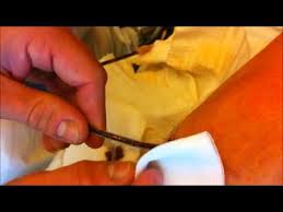 Bacterial contamination of redon drainage systems was seen in 25% of the aseptic procedures that were. Drainage Ziehen Im Knie Youtube