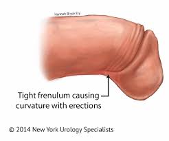 Frenulo del Pene Stretto o Corto - Adult Circumcision in NYC