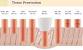 Folliculitis After Laser Hair Removal Treatment