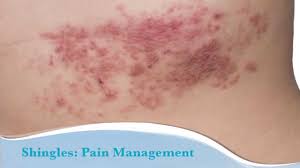 Image result for shingles in children