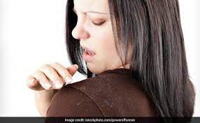 Among the many applications of bicarbonate, is to work as a home remedy against dandruff. 8 Easy Home Remedies To Get Rid Of Dandruff Ndtv Food