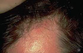 Many people call it dandruff. Is Seborrheic Dermatitis Hair Loss Permanent Dr Yu S Formula Natural Traditional Chinese Medicine For Hair Loss Dr Yu S Formula